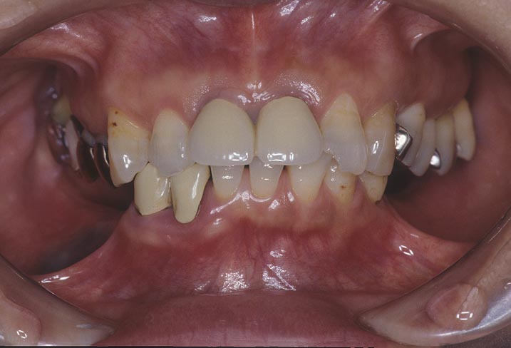 下関市のおおむら歯科医院でセラミック、インプラント、歯周病、矯正治療を行なった症例が専門誌に掲載されました。その治療前の写真です。